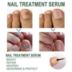 Nail Fungus Treatment Oil (Imported)